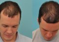 Hair Transplant