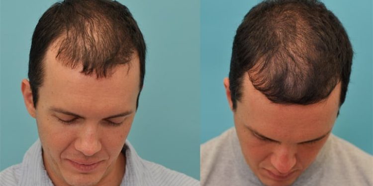 Hair Transplant