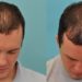 Hair Transplant