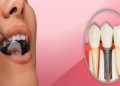 Why Choose Dental Implants Newcastle for a confident Smile