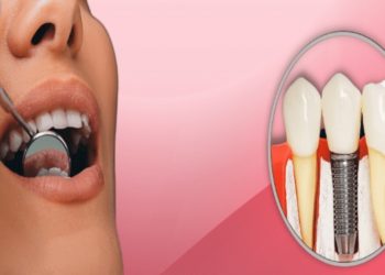 Why Choose Dental Implants Newcastle for a confident Smile