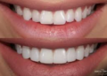 Discover the Benefits of Composite Bonding in Middlesbrough
