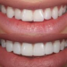 Discover the Benefits of Composite Bonding in Middlesbrough
