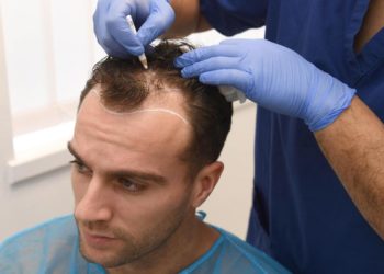 hair transplant