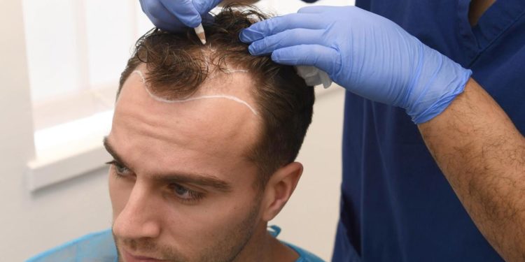 hair transplant