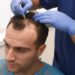 hair transplant