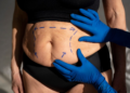 Tips for a Successful Recovery After a Fleur de Lis Abdominoplasty