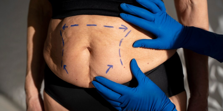 Tips for a Successful Recovery After a Fleur de Lis Abdominoplasty