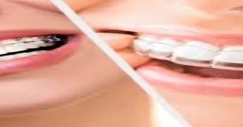 Dental Implants Middlesbrough: Expert Care at Westmount Dental Surgery