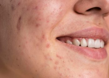The Science Behind Scarring: How and Why Our Skin Heals the Way It Does