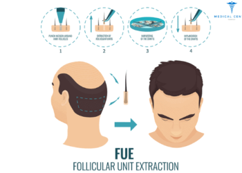 FUE Hair Transplant