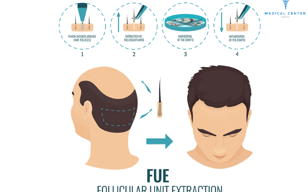 FUE Hair Transplant