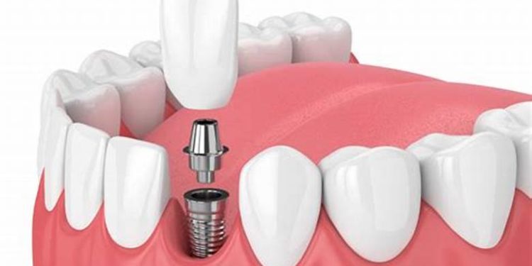 Dental Implants