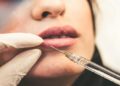 Lip Filler Injection