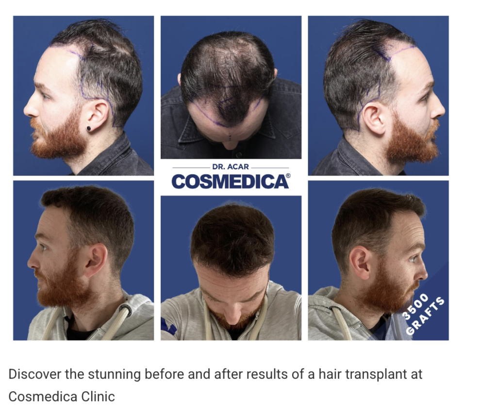 Before and after results of a hair transplant at Cosmedica Clinic