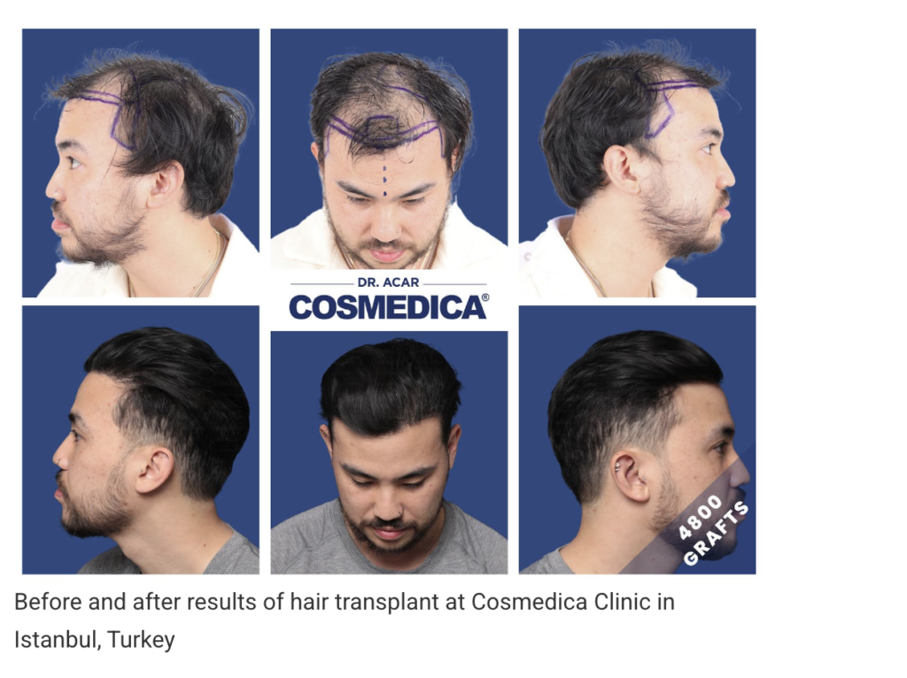 Before and after results of a hair transplant at Cosmedica Clinic