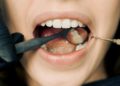 Dental Filling