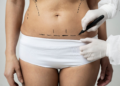 Liposuction