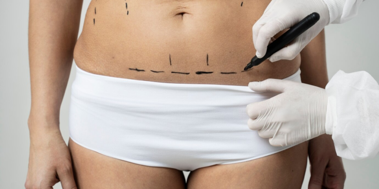 Liposuction