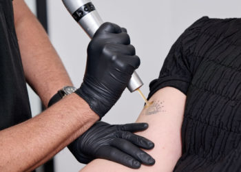 Tattoo Removal