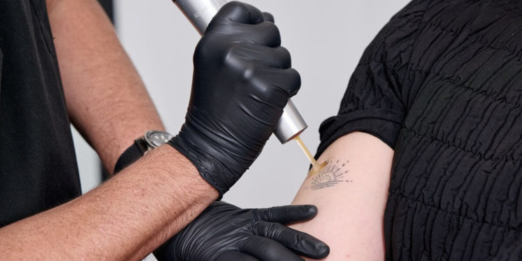 Tattoo Removal