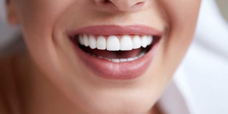 Veneers