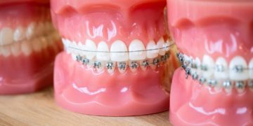 Braces