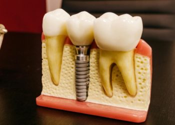 Is a Dental Implant the Best Option for Tooth Replacement?