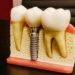 Is a Dental Implant the Best Option for Tooth Replacement?