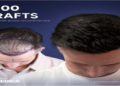 Before and after hair transplant image showing significant improvement. The left shows a bald scalp; the right shows thick, dark hair. Text reads “5000 grafts.”