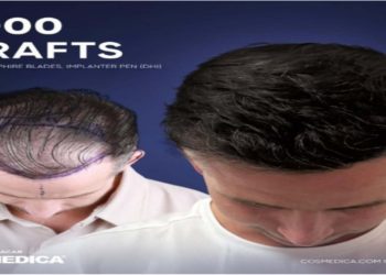 Before and after hair transplant image showing significant improvement. The left shows a bald scalp; the right shows thick, dark hair. Text reads “5000 grafts.”