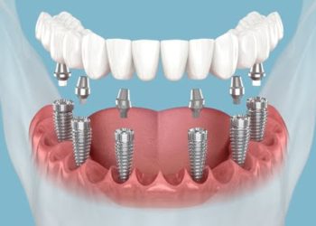 Dental Implants