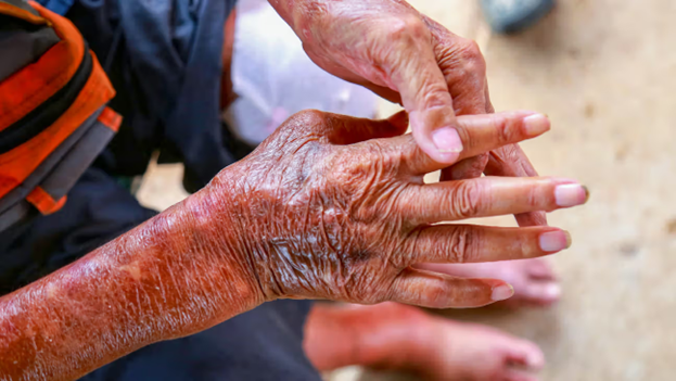 Scleroderma: Transforming Modern Medicine and the Future of Disease Treatment