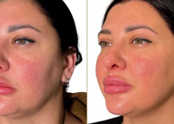 Endolift: The Non-Surgical Lift Transforming UK Aesthetics