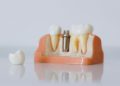 How Dental Implants Improve Confidence And Oral Function