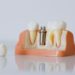 How Dental Implants Improve Confidence And Oral Function