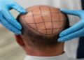 Why Hair Transplants Are Becoming More Popular Among Business Leaders