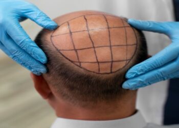 Why Hair Transplants Are Becoming More Popular Among Business Leaders
