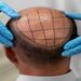 Why Hair Transplants Are Becoming More Popular Among Business Leaders