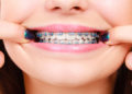 Orthodontic Treatment