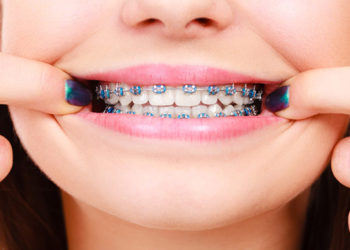 Orthodontic Treatment