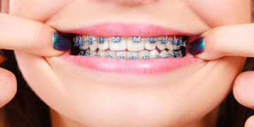 Orthodontic Treatment