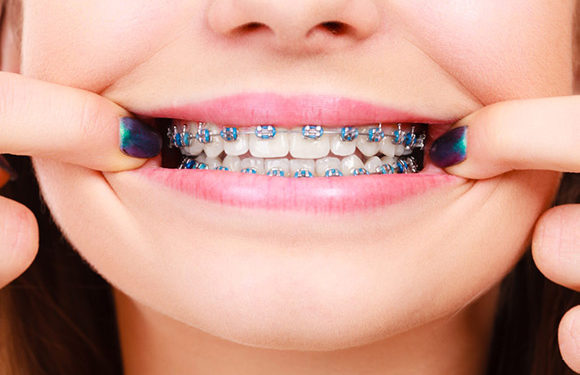 Orthodontic Treatment