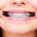 Orthodontic Treatment