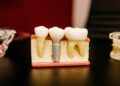 Dental Implants Turkey