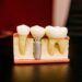 Dental Implants Turkey
