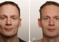 Volumetric Facelift