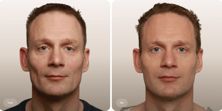Volumetric Facelift