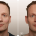 Volumetric Facelift