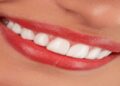 Composite Veneers Turkey: What Should You Know Before Treatment?